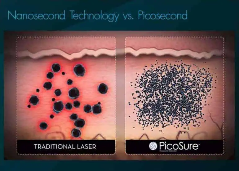 Picosecond vs Nanosecond
